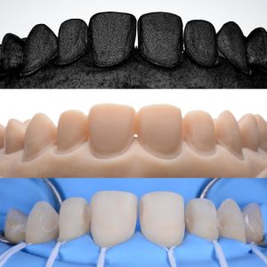 Perfect Tooth Preparation & Workflow